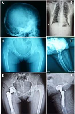 A young woman with atypical McCune–Albright syndrome and the difficult road to recovery: a case report